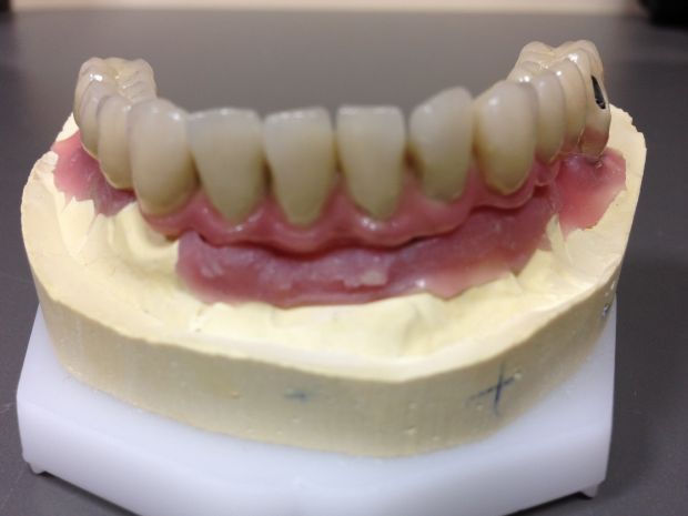 Lower dental long span bridge of metal-fused-to-porcelain, screwed occlusally, with artificial gum of ceramics-2