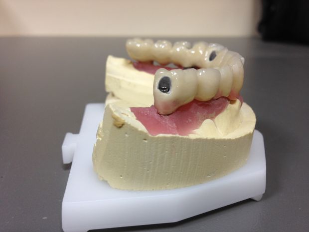Lower dental long span bridge of metal-fused-to-porcelain, screwed occlusally, with artificial gum of ceramics-3