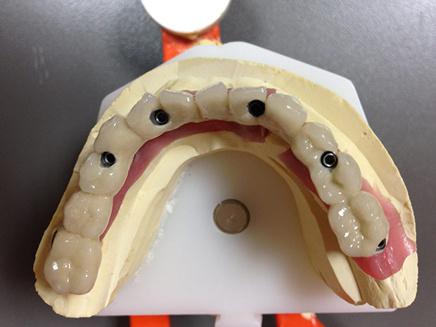 Lower dental long span bridge of metal-fused-to-porcelain, screwed occlusally, with artificial gum of ceramics