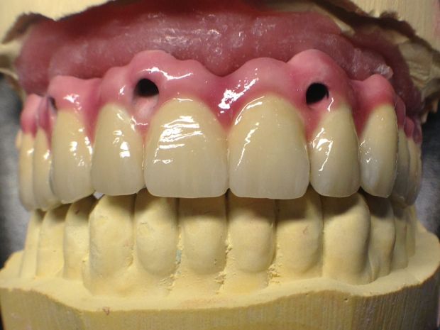 Upper dental long span bridge of metal-fused-to-porcelain, screwed occlusally, with artificial gum of ceramics