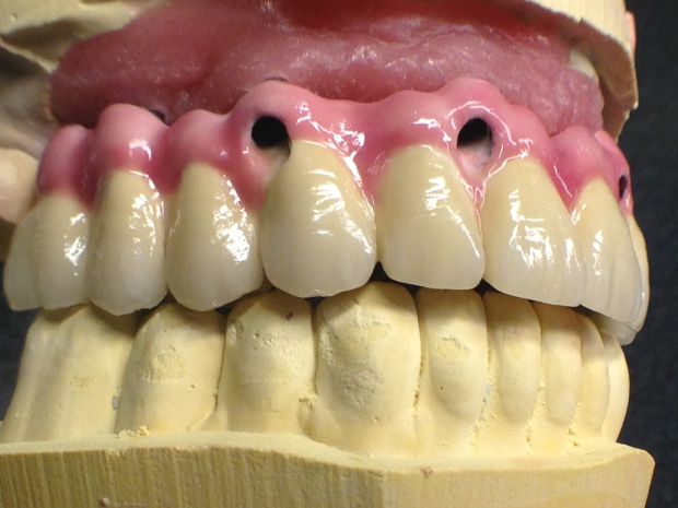 Upper dental long span bridge of metal-fused-to-porcelain, screwed occlusally, with artificial gum of ceramics-2