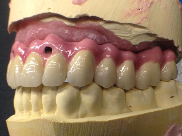 Upper dental long span bridge of metal-fused-to-porcelain, screwed occlusally, with artificial gum of ceramics-3
