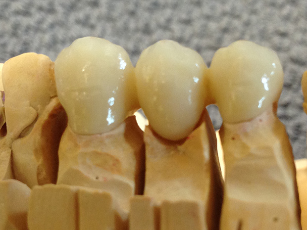 Fitting of a zirconium frame on a control model-4