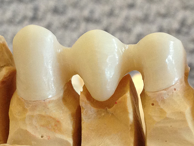 Fitting of a zirconium frame on a control model-3