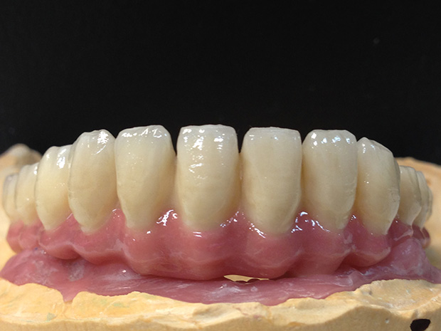Lower dental long span bridge of zirconium, screwed occlusally, with artificial gum of ceramics