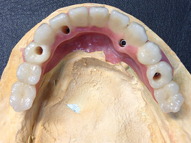 Lower dental long span bridge of zirconium, screwed occlusally, with artificial gum of ceramics-2