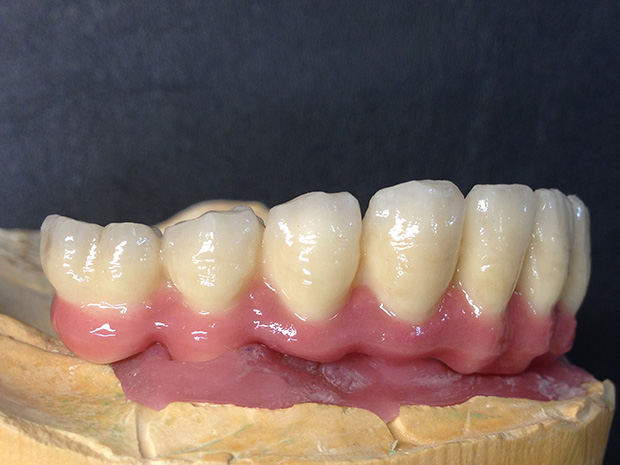 Lower dental long span bridge of zirconium, screwed occlusally, with artificial gum of ceramics-3