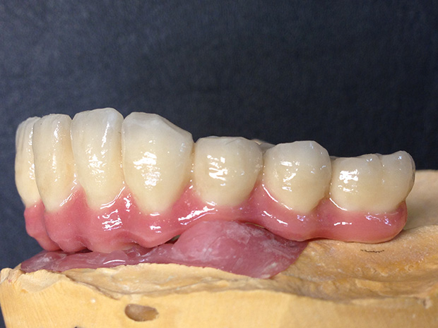 Lower dental long span bridge of zirconium, screwed occlusally, with artificial gum of ceramics-4