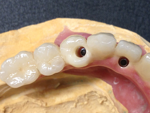 Lower dental long span bridge of zirconium, screwed occlusally, with artificial gum of ceramics