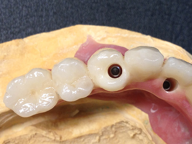 Lower dental long span bridge of zirconium, screwed occlusally, with artificial gum of ceramics-2