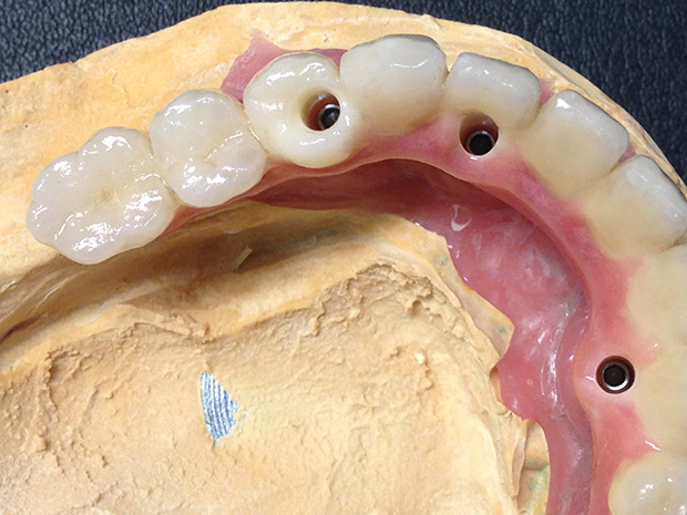 Lower dental long span bridge of zirconium, screwed occlusally, with artificial gum of ceramics-3