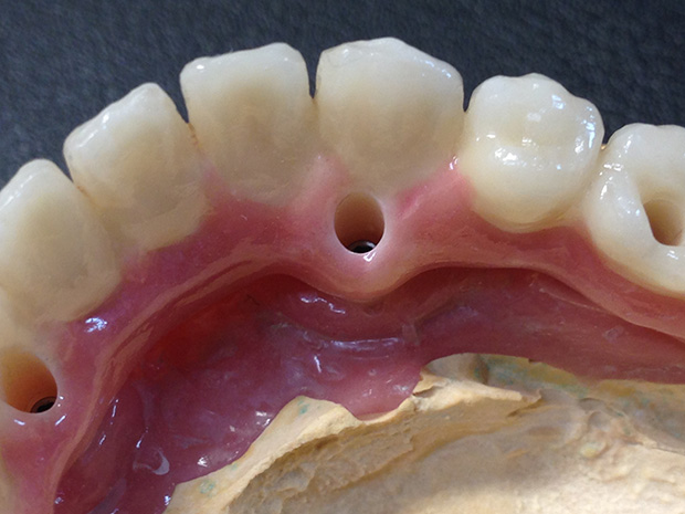 Lower dental long span bridge of zirconium, screwed occlusally, with artificial gum of ceramics-4