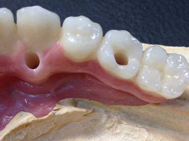 Lower dental long span bridge of zirconium, screwed occlusally, with artificial gum of ceramics-5