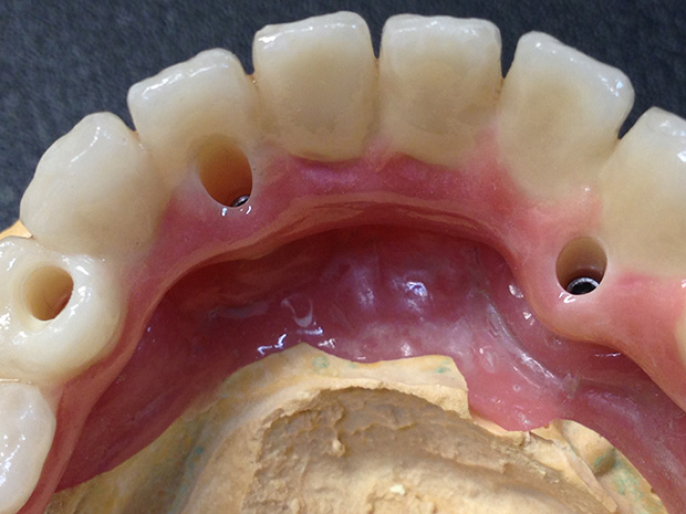 Lower dental long span bridge of zirconium, screwed occlusally, with artificial gum of ceramics-6