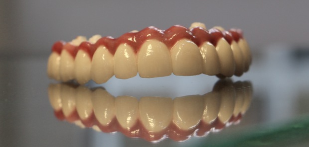 Porcelain bonded upper dental long span bridge of zirconium, screwed occlusally, with artificial gingiva