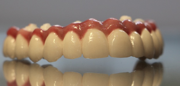 Porcelain bonded upper dental long span bridge of zirconium, screwed occlusally, with artificial gingiva-2