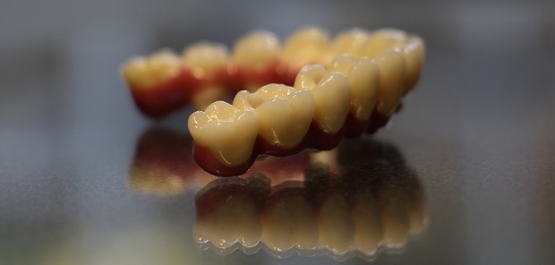 Porcelain bonded upper dental long span bridge of zirconium, screwed occlusally, with artificial gingiva-3