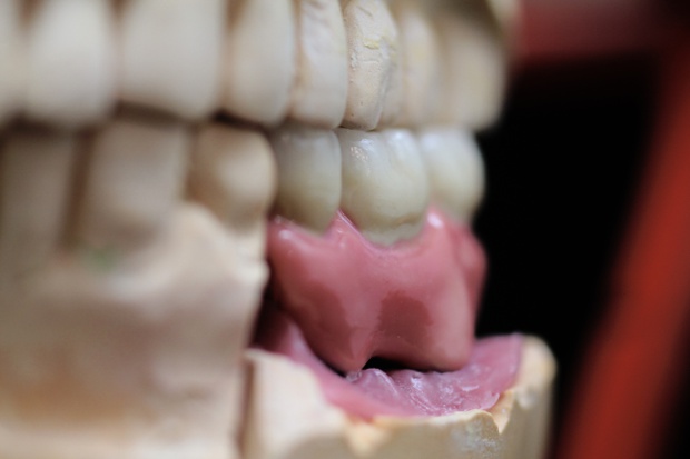 Implant retained posterior bridge with super sized gingiva