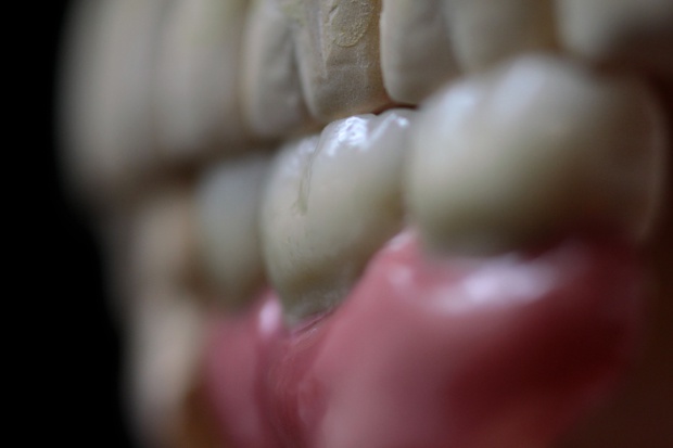 Implant retained posterior bridge with super sized gingiva-2