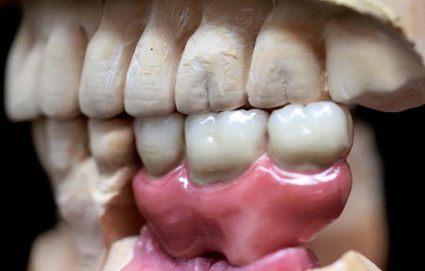 Implant retained posterior bridge with super sized gingiva-3