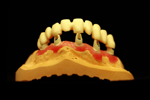 Zirconium dental long span bridge on individual zirconium abutments