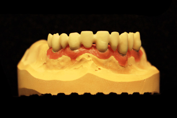 Zirconium dental long span bridge on individual zirconium abutments-2