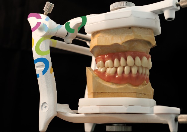 Hybrid prosthesis on the upper jaw & bar retained denture on the lower