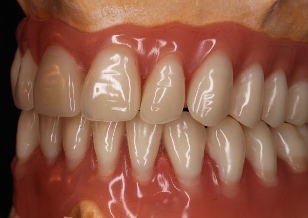 Hybrid prosthesis on the upper jaw & bar retained denture on the lower-2