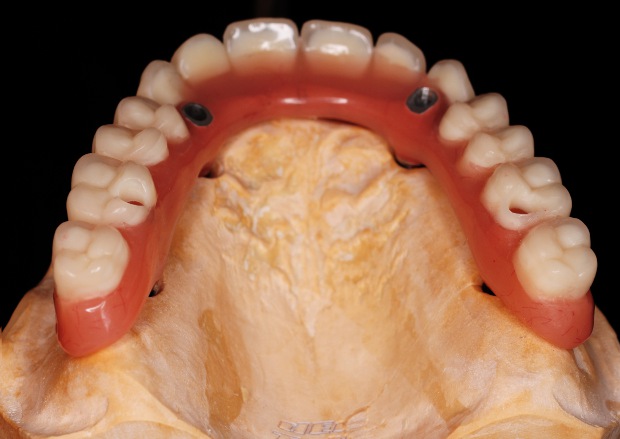 Hybrid prosthesis on the upper jaw & bar retained denture on the lower-3