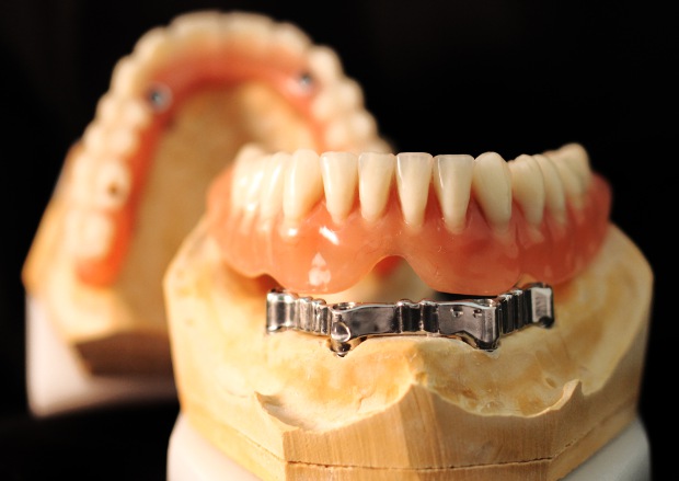 Hybrid prosthesis on the upper jaw & bar retained denture on the lower-4
