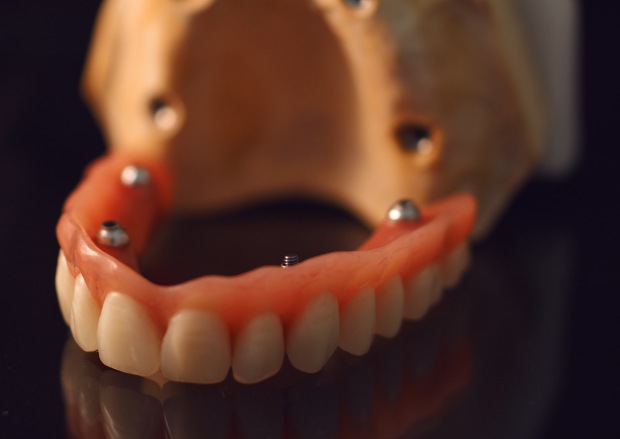 Hybrid prosthesis on the upper jaw & bar retained denture on the lower-5