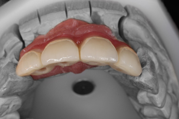 Upper dental bridge of zirconium, screw retained with curved bores for the perfect anterior aesthetic