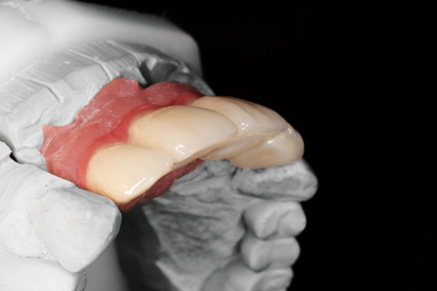 Upper dental bridge of zirconium, screw retained with curved bores for the perfect anterior aesthetic-2