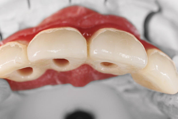 Upper dental bridge of zirconium, screw retained with curved bores for the perfect anterior aesthetic-3