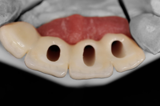 Upper dental bridge of zirconium, screw retained with curved bores for the perfect anterior aesthetic-4