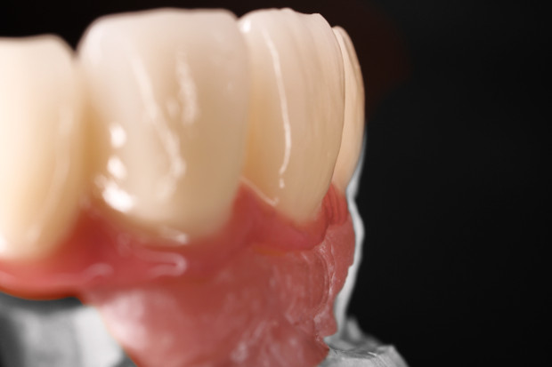 Upper dental bridge of zirconium, screw retained with curved bores for the perfect anterior aesthetic-5
