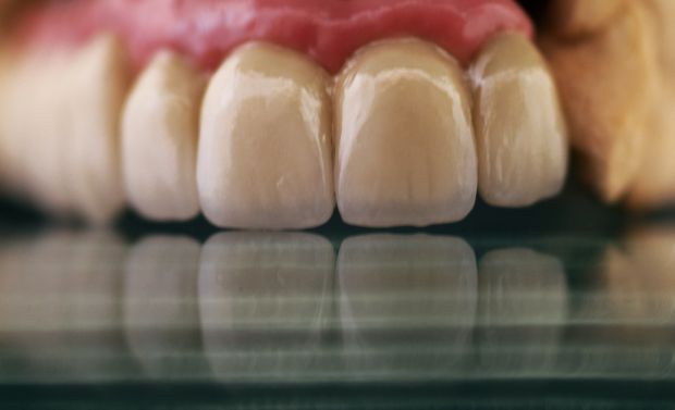 Upper dental bridge of metal-fused-to-porcelain, implant retained by cement, with artificial gum of ceramics-2