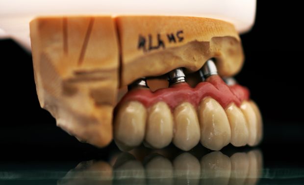 Upper dental bridge of metal-fused-to-porcelain, implant retained by cement, with artificial gum of ceramics