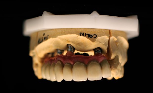 Upper dental bridge of metal-fused-to-porcelain, implant retained by cement, with artificial gum of ceramics-3