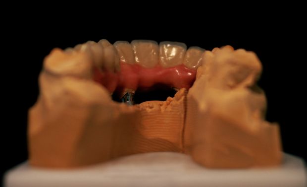 Upper dental bridge of metal-fused-to-porcelain, implant retained by cement, with artificial gum of ceramics-4