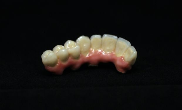 Upper dental bridge of metal-fused-to-porcelain, implant retained by cement, with artificial gum of ceramics-5