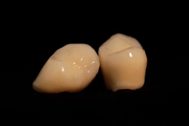 Porcelain bonded zirconium solo crowns-4