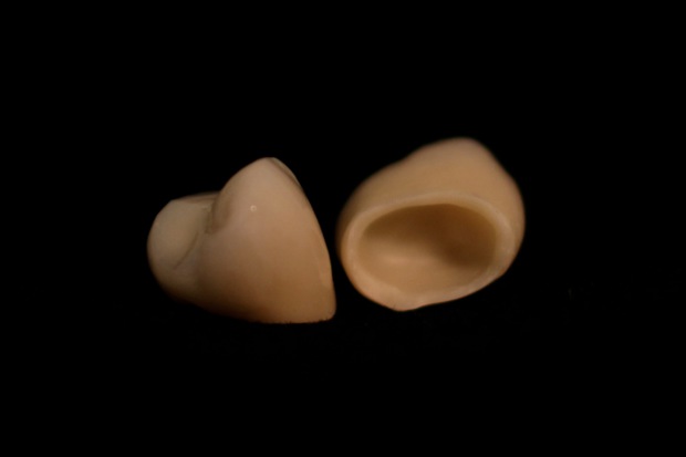 Porcelain bonded zirconium solo crowns-5