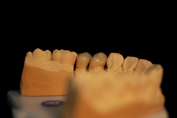 Porcelain bonded zirconium solo crowns-2