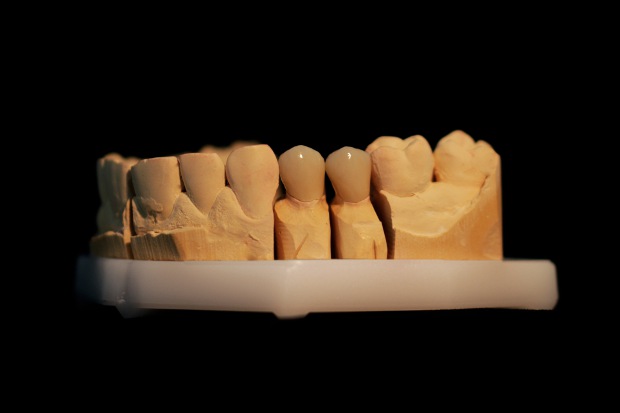 Porcelain bonded zirconium solo crowns-3