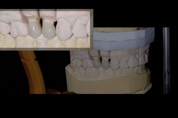 Porcelain bonded zirconium solo crowns