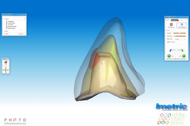 Design and implementation of CAD/CAM crown-2