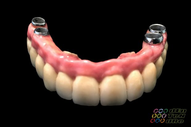 Full upper arch rehabilitation on intraocclusal screw retained implants, biscuit try in and fit appointment.