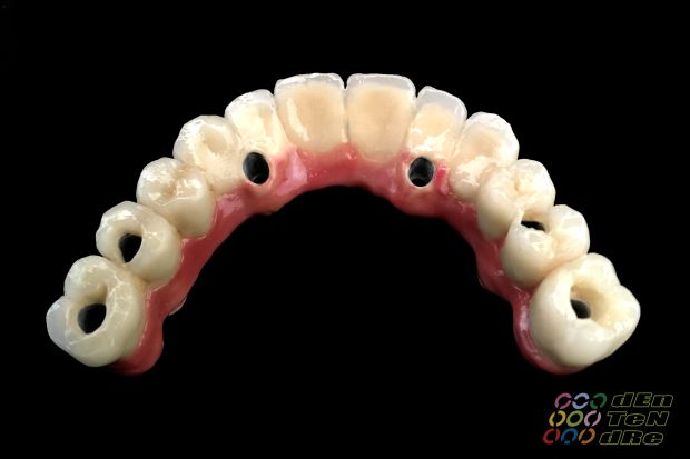 Full upper arch rehabilitation on intraocclusal screw retained implants, biscuit try in and fit appointment.-2