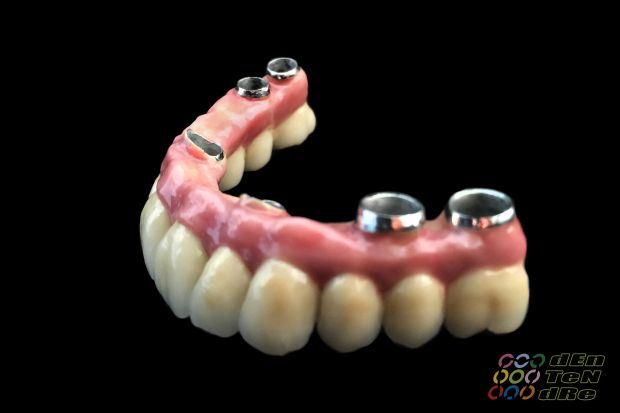 Full upper arch rehabilitation on intraocclusal screw retained implants, biscuit try in and fit appointment.-3
